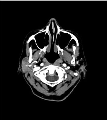 Head and Neck Phantom for CT, X-ray and radiation therapy