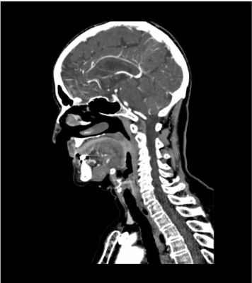 Head and Neck Phantom for CT, X-ray and radiation therapy