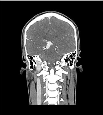 Head / neck CTA phantom AVM