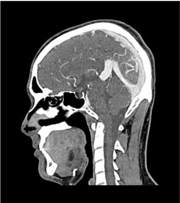 Head / neck CTA phantom AVM