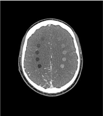 Head and Neck Phantom “AVM and Lesion” for CT, X-ray and radiation therapy