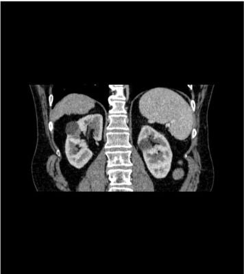 Abdomen phantom pv cirrhosis