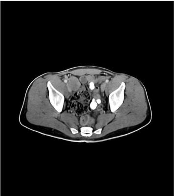 Abdomen/Pelvis Phantom Portal venous phase