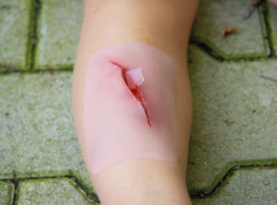 Wound moulage "cut with glass fragment"