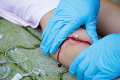 Wound moulage "cut with glass fragment"