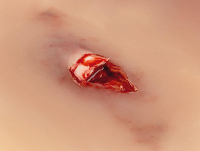 Wound moulage "open fracture"