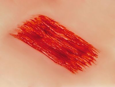 Wound moulage "abrasion"