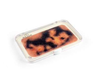 Wound moulage 3rd degree burn