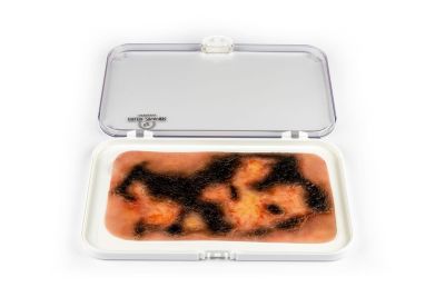 Wound moulage 3rd degree burn