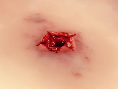 Wound moulage bullet exit hole