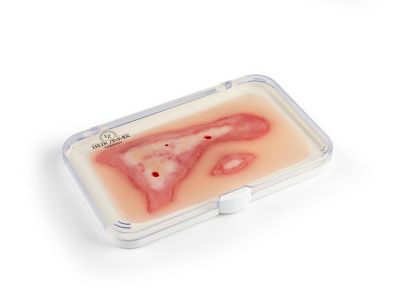 Wound moulage scalding