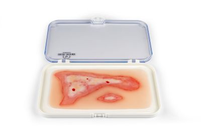Wound moulage scalding