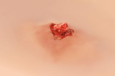 Wound moulage open fracture, arm bone with bleeding function