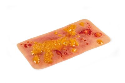 Wound moulage 2nd degree burn