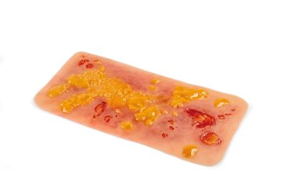 Wound moulage 2nd degree burn