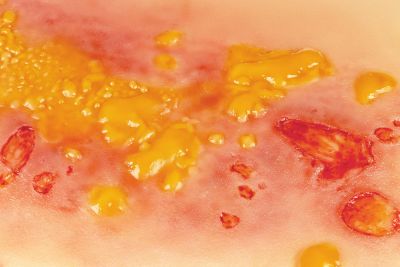 Wound moulage 2nd degree burn