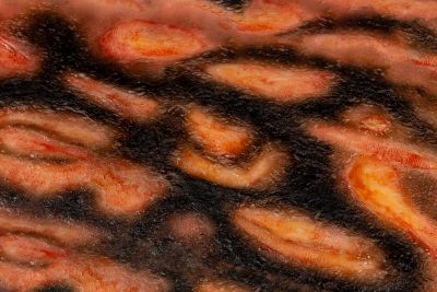 Wound moulage 3rd degree burn