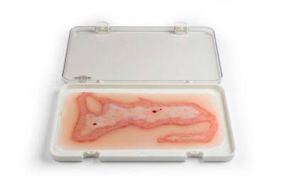 Wound moulage scalding