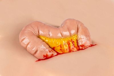 Wound moulage protrusion of large intestines