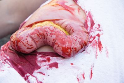Wound moulage protrusion of large intestines