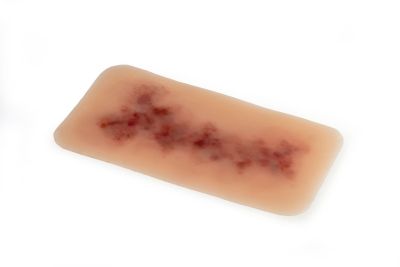 Wound moulage Hematoma older