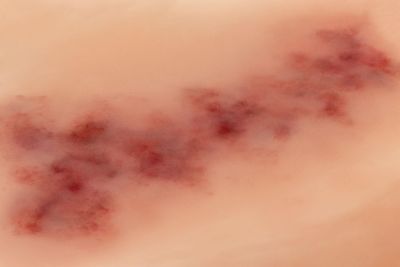 Wound moulage Hematoma older