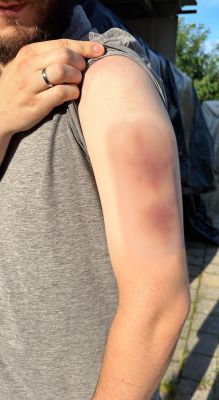 Wound moulage Hematoma older