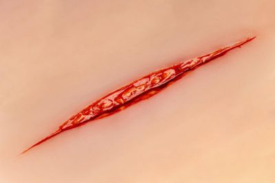 Wound moulage Suicide attempt