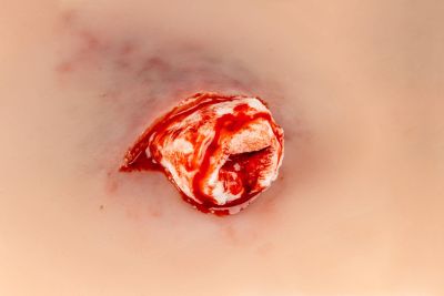 Wound presentation open fracture ankle joint