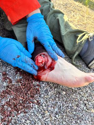 Wound presentation open fracture ankle joint