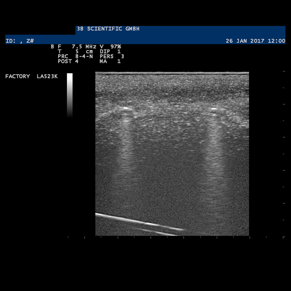 SONOtrain Foreign Body Model, Light Skin