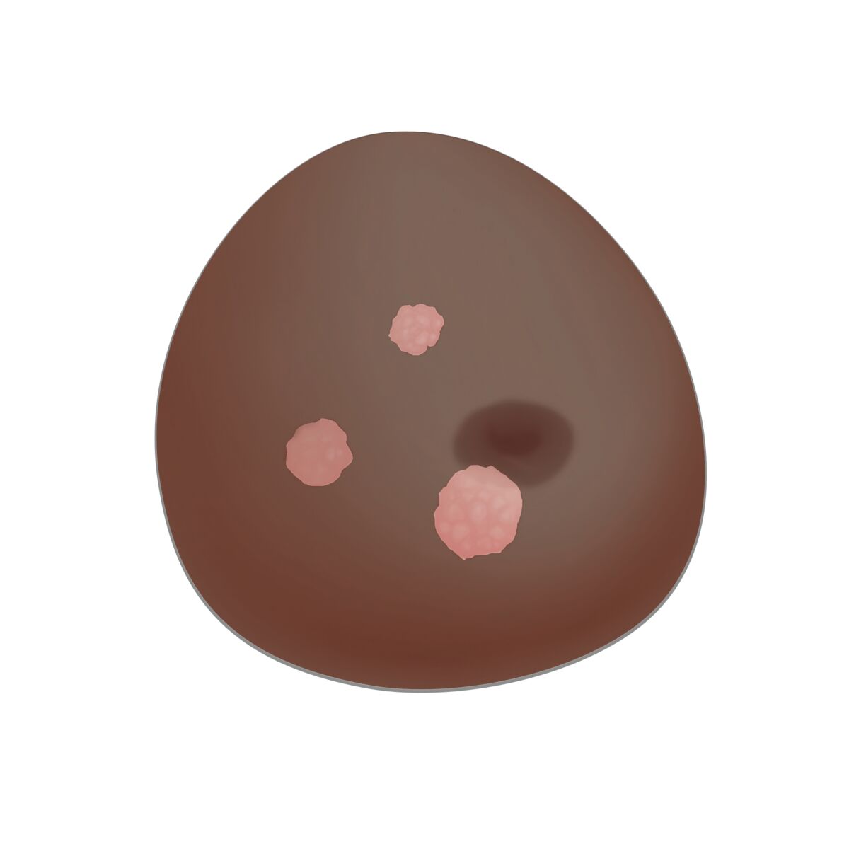 SONOtrain Breast Model with Cysts dark skin