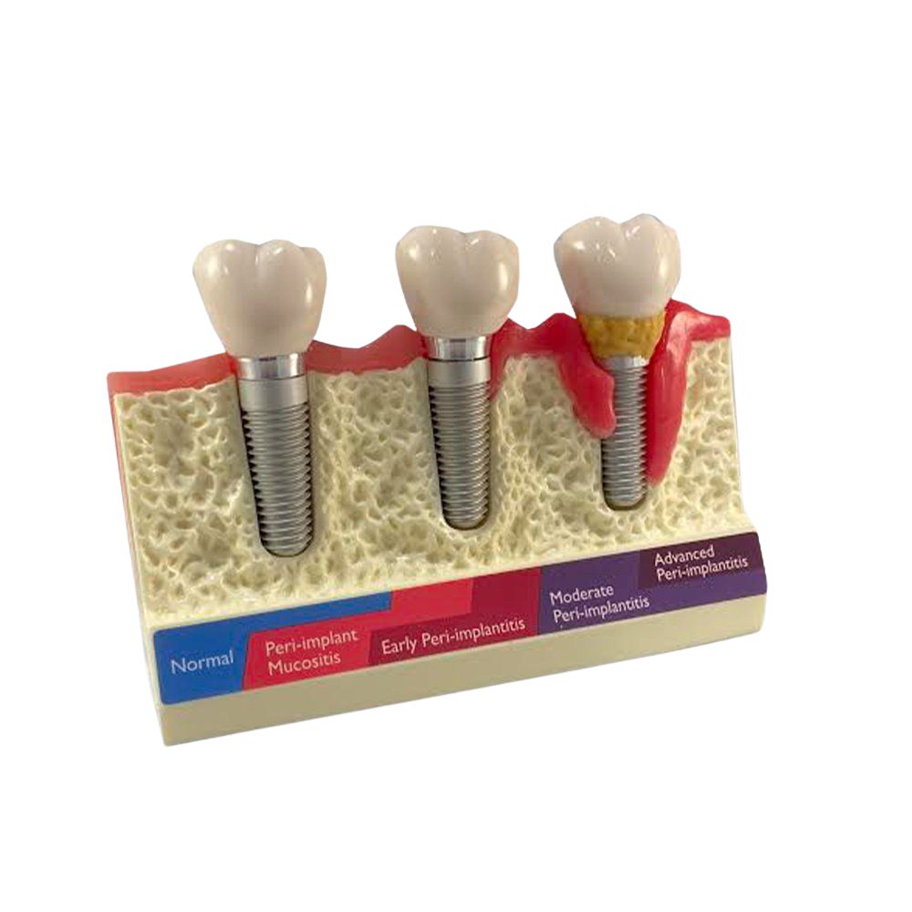 Peri-implantitis cross-sectioned model showing healthy and diseased implant conditions - PE-IMP004