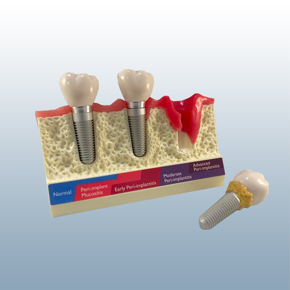 Peri-implantitis model close-up showing subgingival implant condition - PE-IMP004