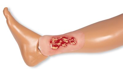 Wound moulage venous leg ulcer, small, exudation phase