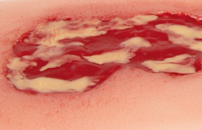 Wound moulage venous leg ulcer, small, exudation phase
