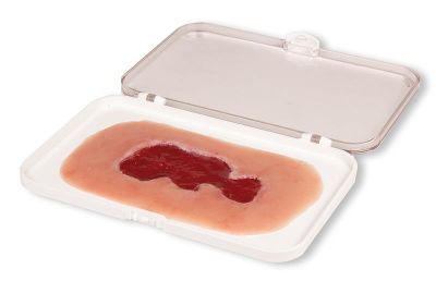 Wound moulage venous leg ulcer, small, granulation phase