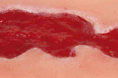 Wound moulage venous leg ulcer, small, granulation phase
