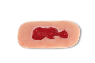 Wound moulage venous leg ulcer, small, granulation phase