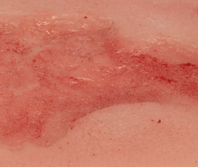 Wound moulage venous leg ulcer, small, epithelization phase