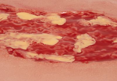 Wound moulage venous leg ulcer, large, exudation phase