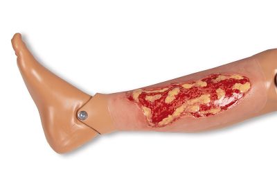 Wound moulage venous leg ulcer, large, exudation phase