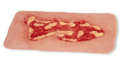 Wound moulage venous leg ulcer, large, exudation phase
