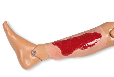 Wound moulage venous leg ulcer, large, granulation phase