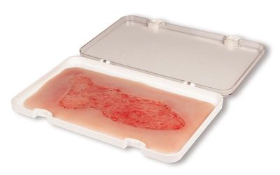 Wound moulage venous leg ulcer, large, epithelization phase