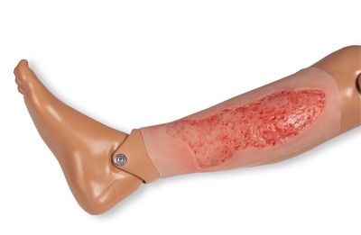 Wound moulage venous leg ulcer, large, epithelization phase