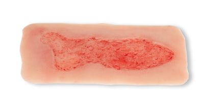 Wound moulage venous leg ulcer, large, epithelization phase