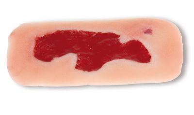 Wound moulage arterial leg ulcer, small, granulation phase