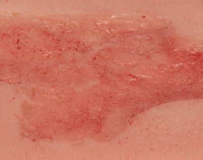 Wound moulage arterial leg ulcer, small, epithelization phase