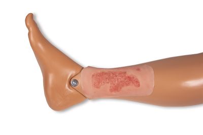 Wound moulage arterial leg ulcer, small, epithelization phase